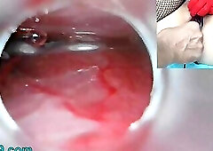 Insemination Cum into Uterus and Endoscope Camera by Cervix