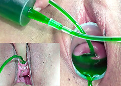 Cervix and Pee Hole Inflation with Injections for Japanese Lesbians